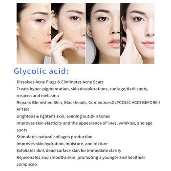 Glicolic rūgštis 35% 5ml glicolic medicina aha odos skustukas Cheminis odos šveitimas rūgšties pašalinti spuogų pockmark šveitimas gydymas